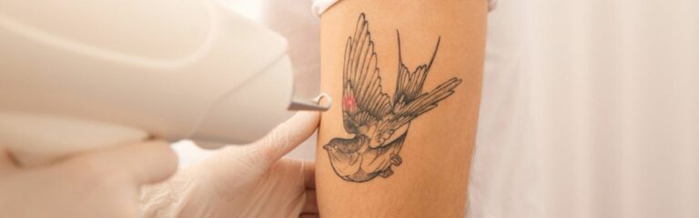 Descubre la eliminación de tatuajes y todo lo que debes tener en cuenta antes del proceso